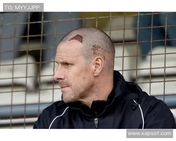 足球明星植发失败引发热议背后真相曝光令人唏嘘不已 足球明星植发失败引发热议背后真相曝光令人唏嘘不已